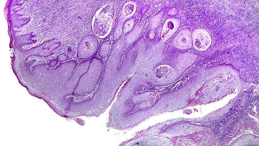 Ученые обнаружили стимулирующие развитие рака кишечника бактерии
