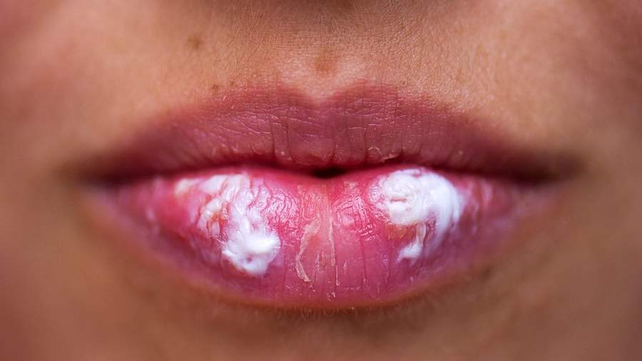 Герпес на губе у детей: причины, симптомы, диагностика и лечение — Статьи — ОН КЛИНИК Бейби