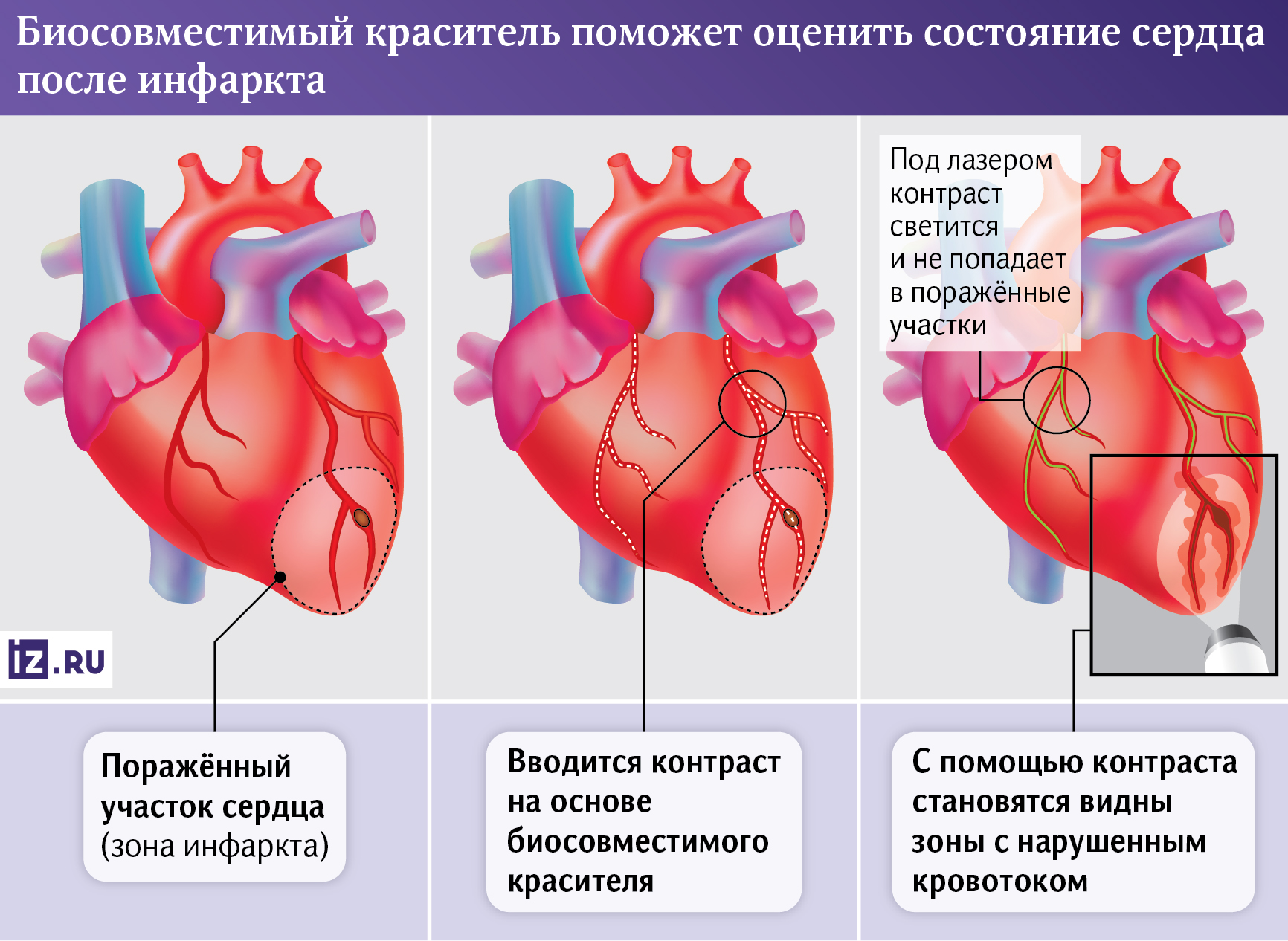 Инфаркт миокарда: признаки, симптомы сердечного приступа, лечение в ФНКЦ ФМБА