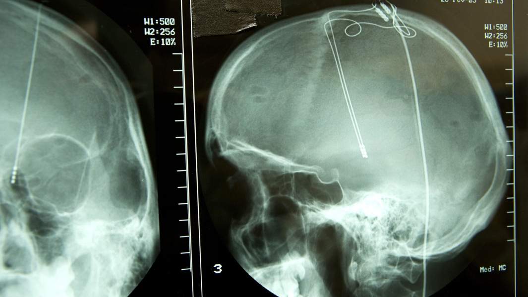 Электростимуляция мозга