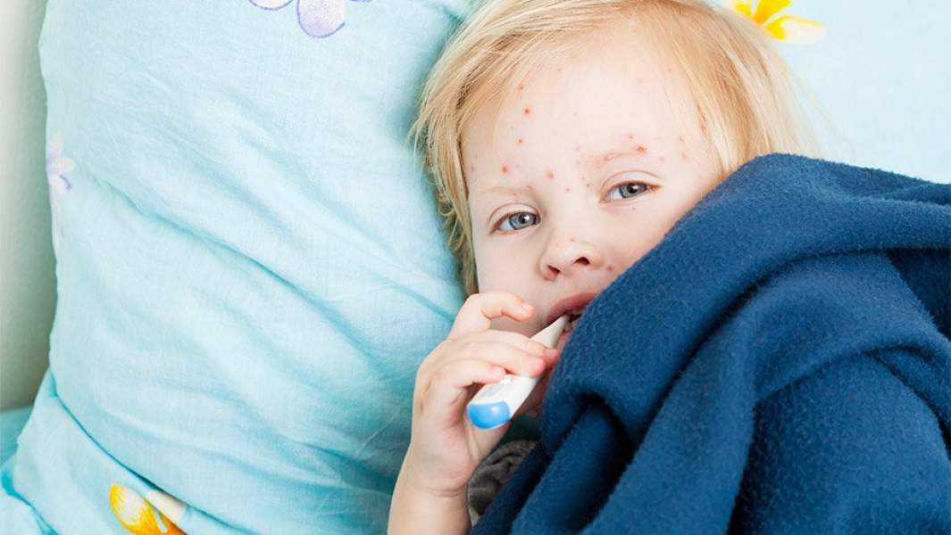 ребенок в сыпи 