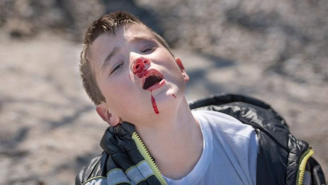 Мальчик с разбитым носом