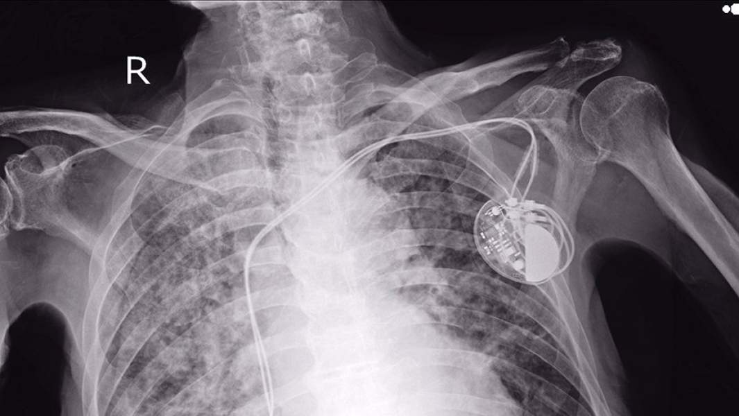 Кардиостимулятор на рентгеновском снимке