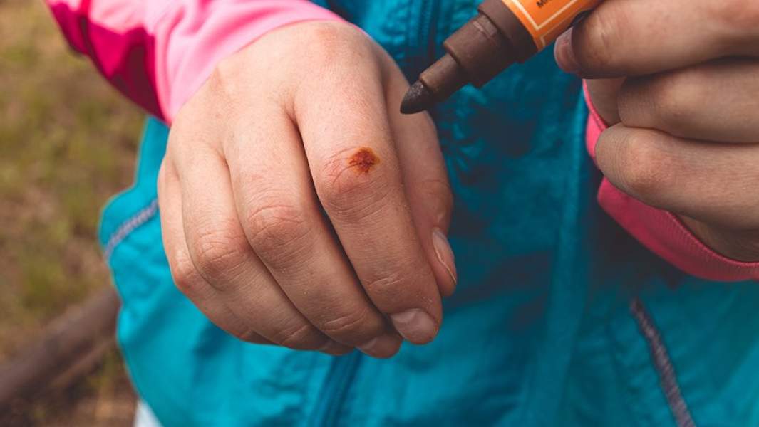 Палец с разрезом и йодом на нем