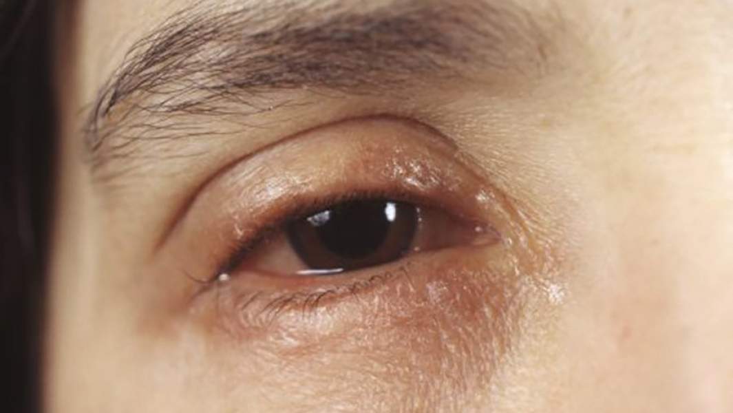 Аллергическая реакция