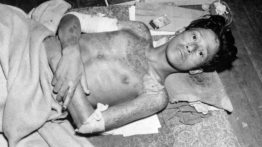 Пострадавший в результате атомной бомбардировки Нагасаки