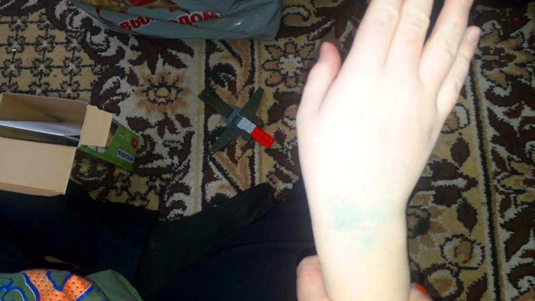 Синяки на руке мальчика, которого избивают дети в Барнаульском центре помощи детям, оставшимся без попечения родителей, № 4