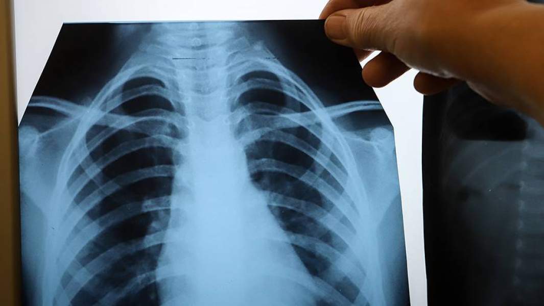 papilloma vírus tesztek az ember számára