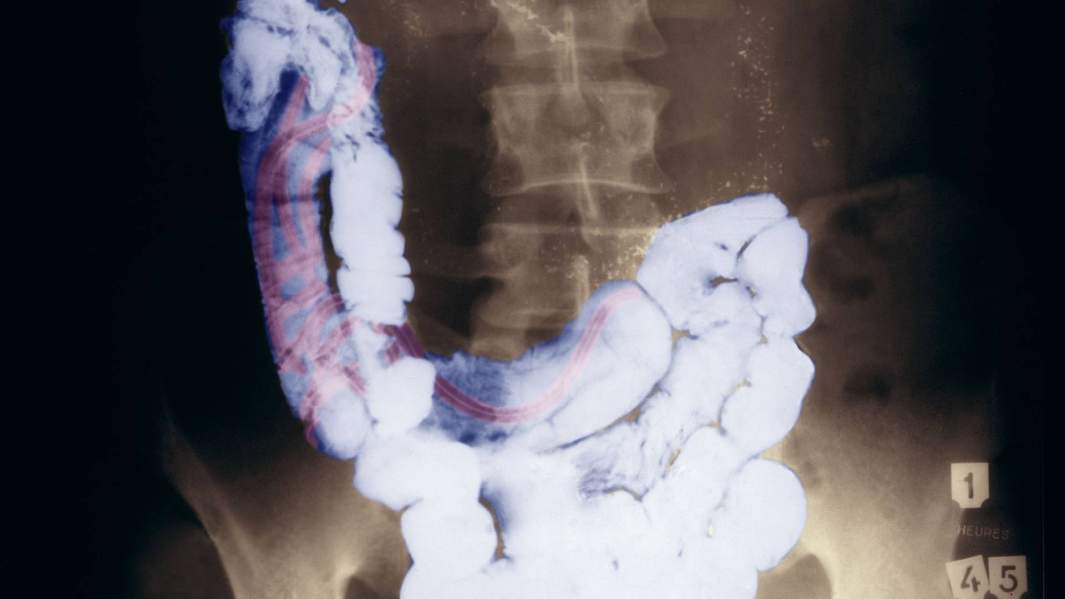 Паразительный эффект: как гельминты обманывают иммунитет при СOVID-19