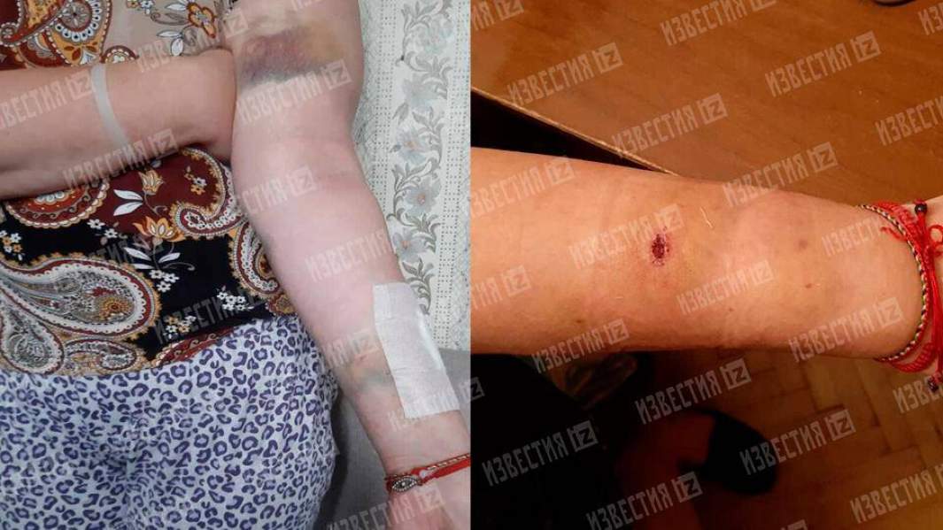 Травмы, полученные Юлией в результате нападения бойцовской собаки