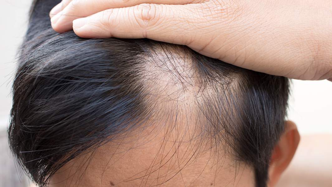 Зуд кожи головы: осознание, причины и методы устранения - Клиника трихологии «Cheveux»