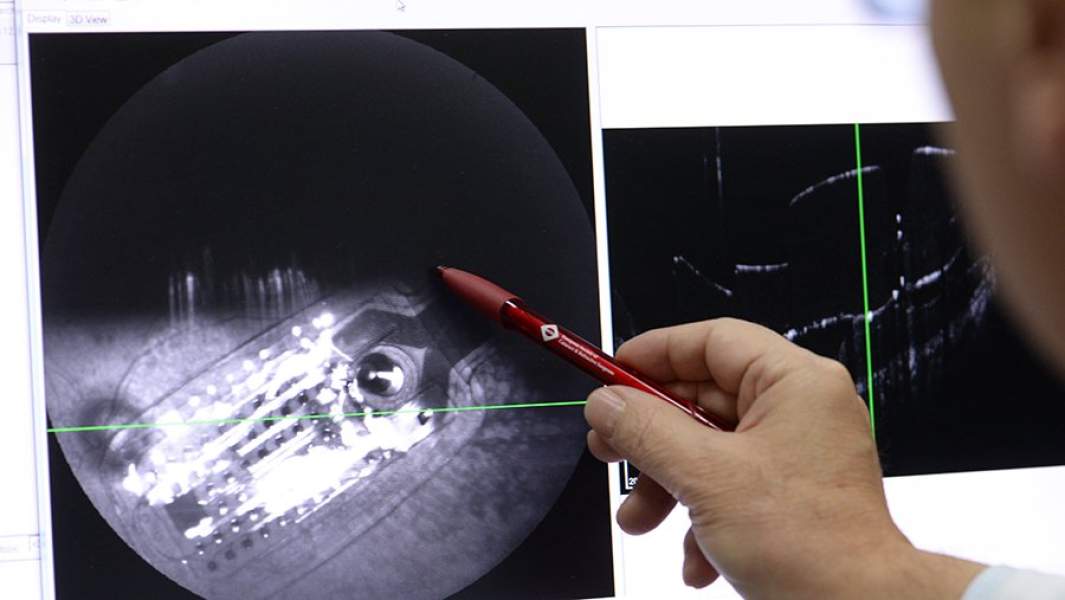 Профессор Христо Тахчиди изучает изображение на мониторе после операции по установке ретинального импланта (протез сетчатки) пациенту