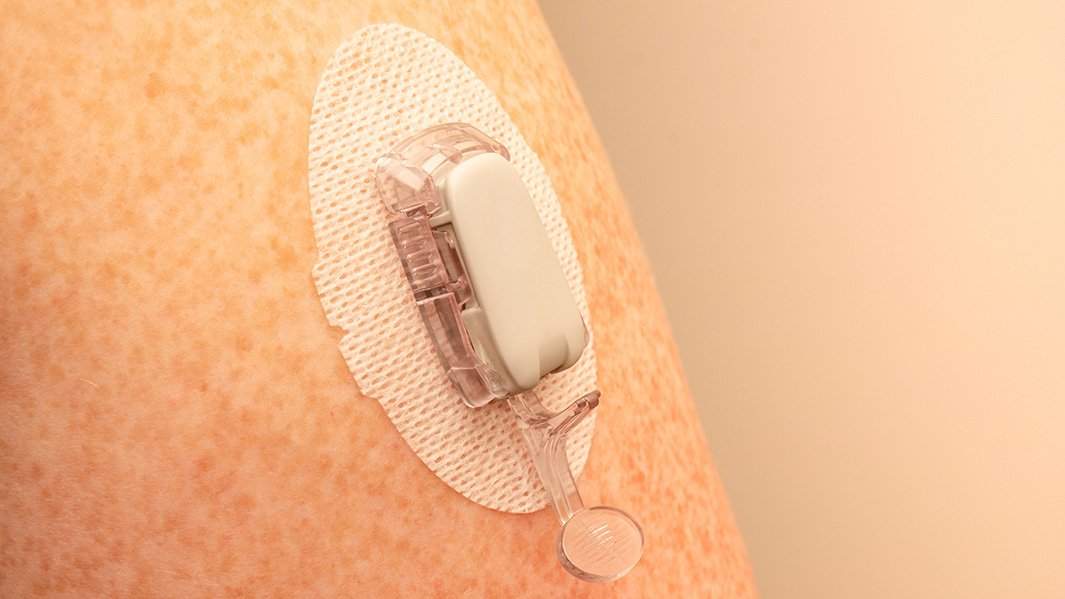 Система непрерывного мониторинга уровня глюкозы