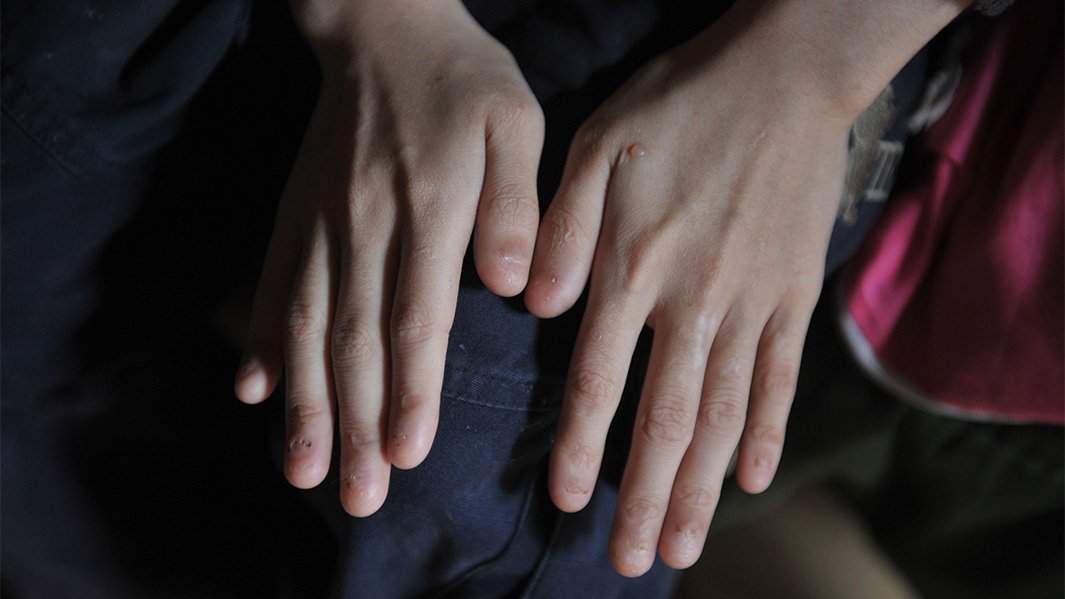 эпидермолиз