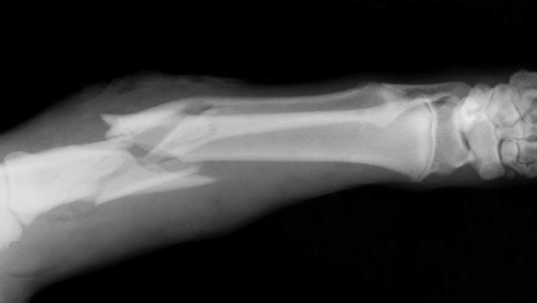 Рентгеновский снимок сломанной кости