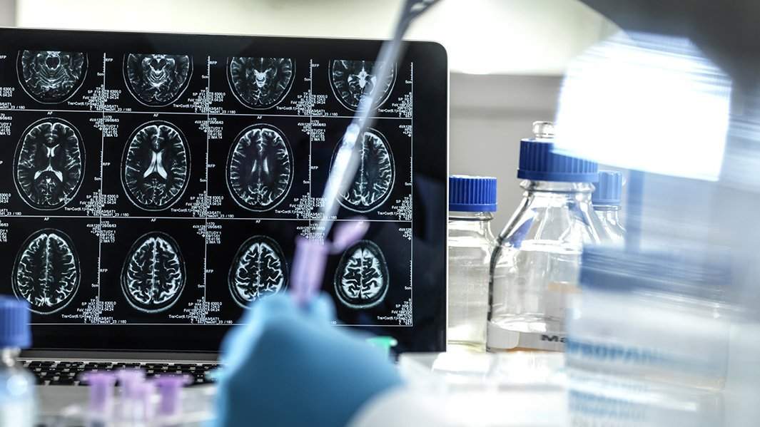 снимок мозг