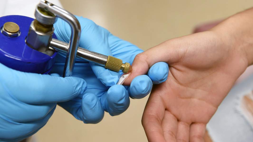 криотерапия