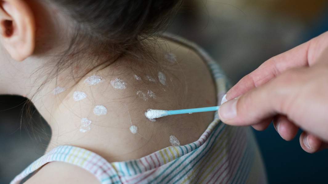 девочка, больная корью