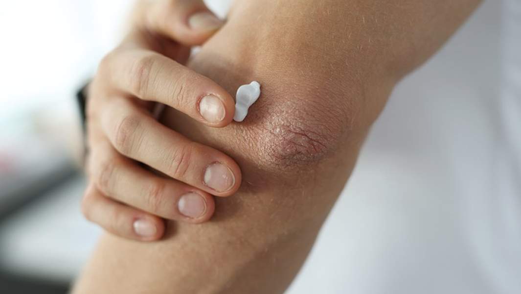 Сухая кожа на локте женщины