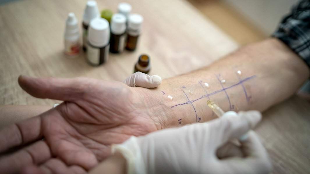 Кожное тестирование на аллергию