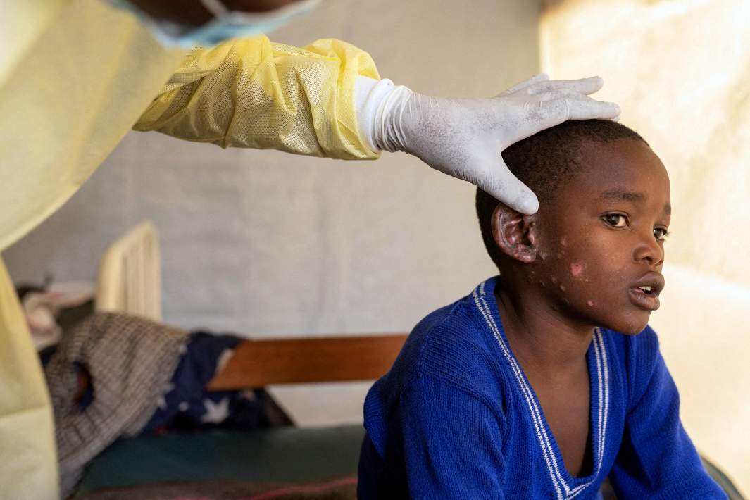 Оспа обезьян в Конго