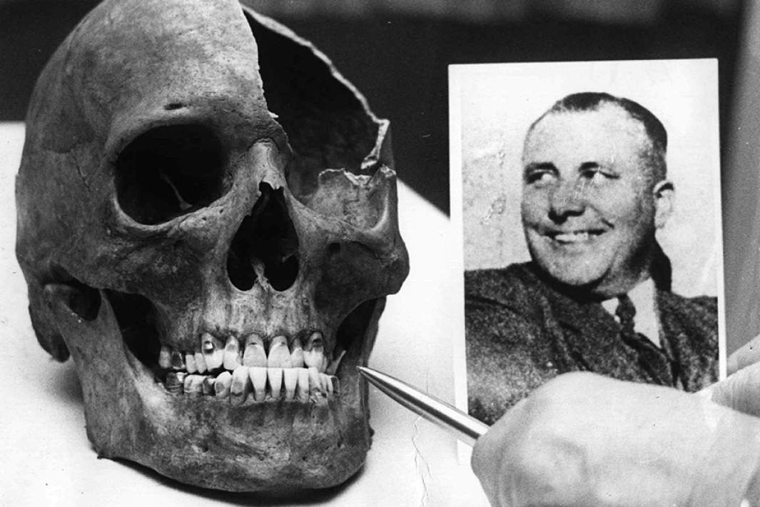 Предполагаемый череп Мартина Бормана, найденный в Берлине в 1972 году