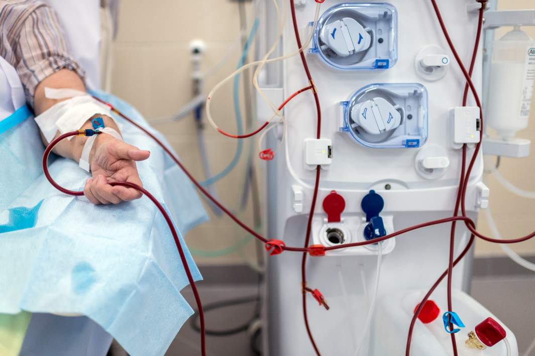 Гемодиализ