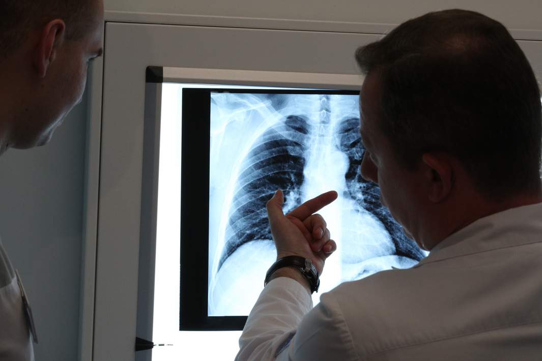 рентген легких