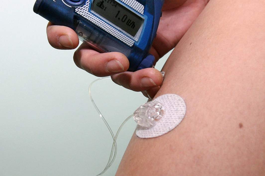 Инсулиновая помпа 