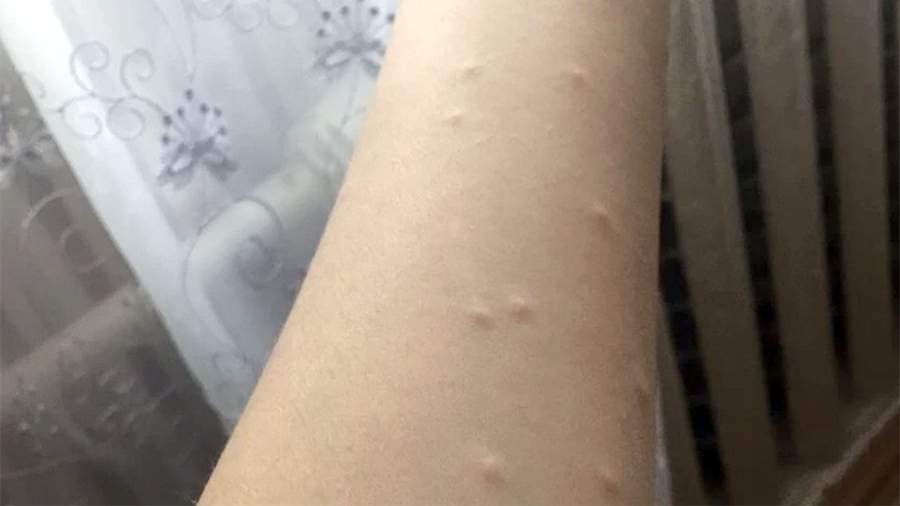 Сыпь на руке девочки, появившаяся после купания в Тургояке