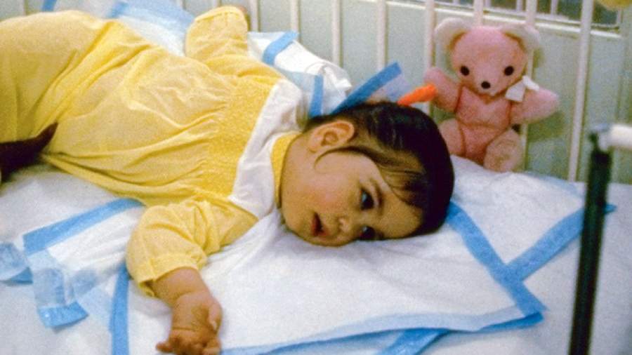 болезнь тея сакса фото