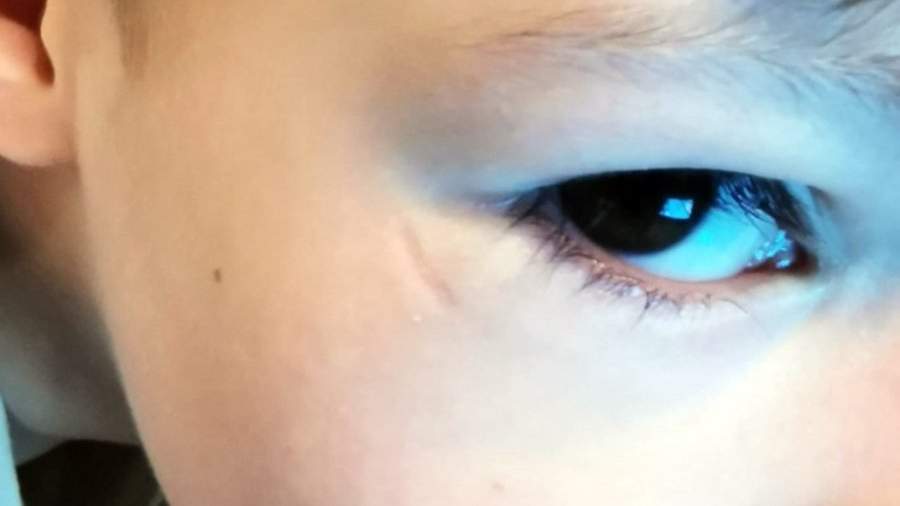 The scar left under the eye of a boy who was injured in the play area of ​​one of the restaurants in Yekaterinburg