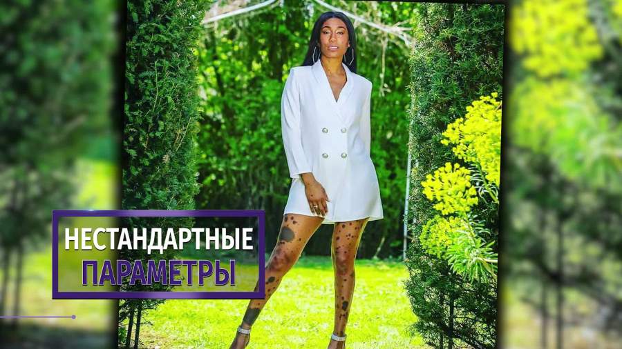 Британка со множеством родинок на теле стала моделью